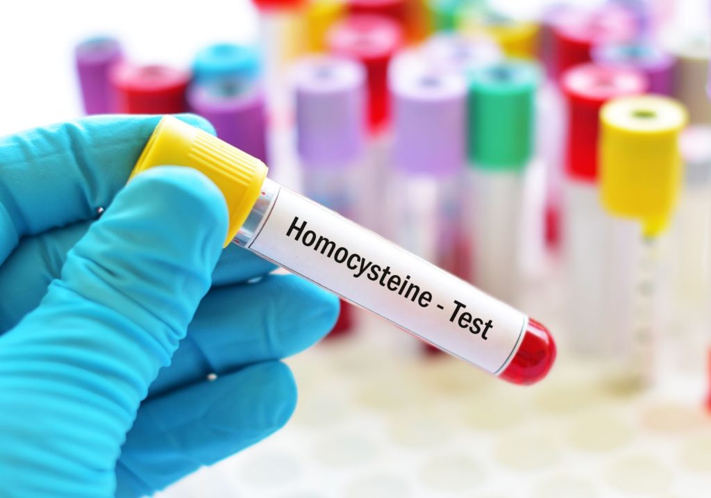 How to Test Homocysteine
